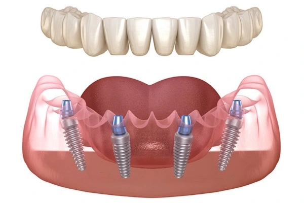 Full Mouth Rehab