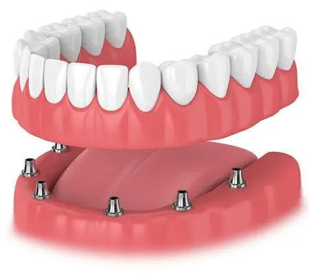 Implant-Supported Overdentures Oraa Care