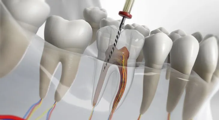 Microscopic Root Canal
